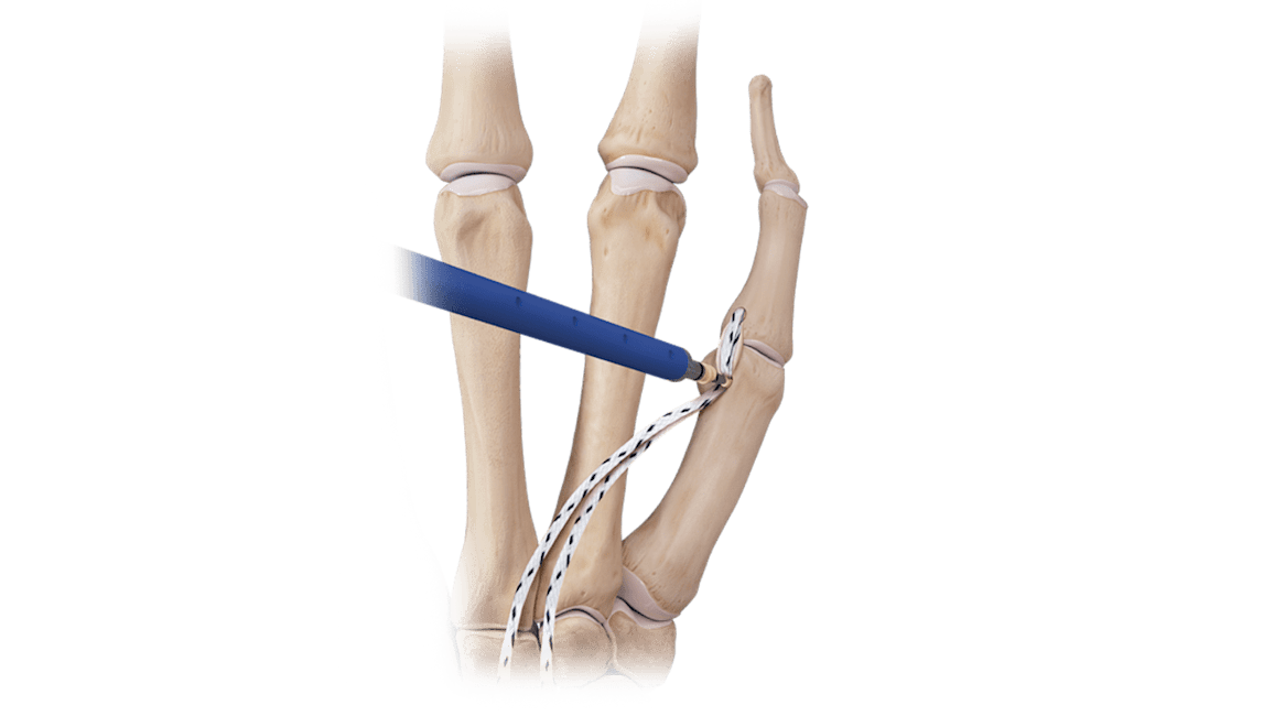 AO法骨折治療hand and wrist 81ZOz2KOy0L.jpg